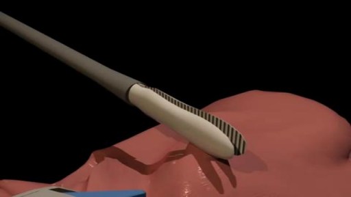 ⁣Video-assisted thoracoscopic surgery (VATS)