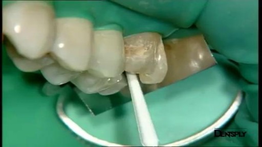 ⁣Art restoration of anterior teeth