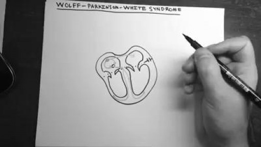 ⁣Wolff-Parkinson-White Syndrome