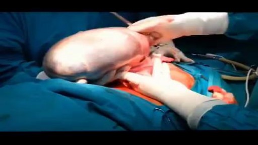 ⁣Huge Ovarian Cyst Removal Surgery