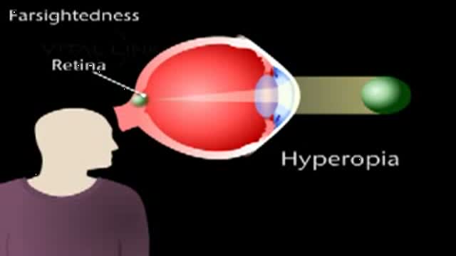 Hyperopia Animation