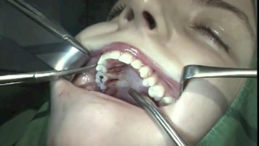 ⁣wisdom teeth removal - surgery,extraction