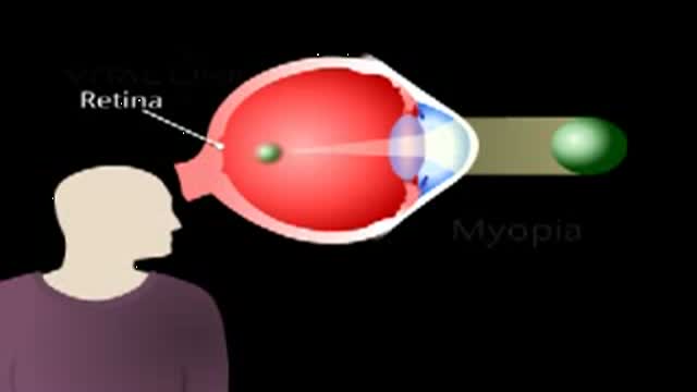 ⁣Myopia Animation
