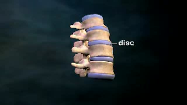 Disc Prolapse