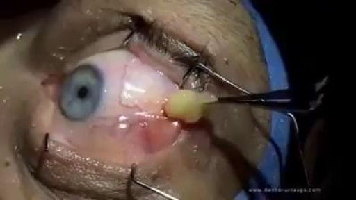 Eyeball cyst Removal