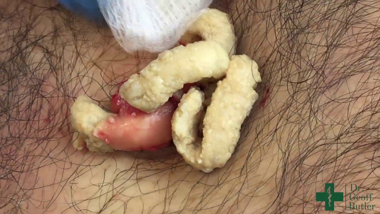 ⁣Removal of a large epidermal cyst in the chest