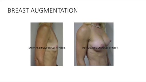 ⁣Breast Augmentation with Cohesive Gel Implants Procedure by Dr. Ajaya Kashyap