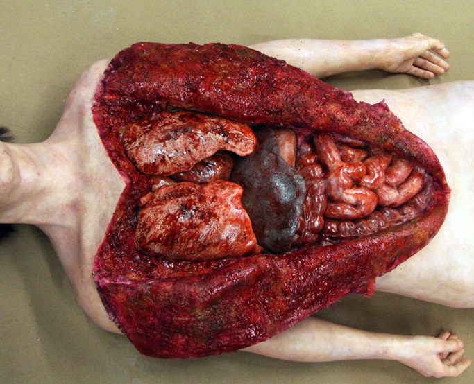 Full Human Body Medical Autopsy