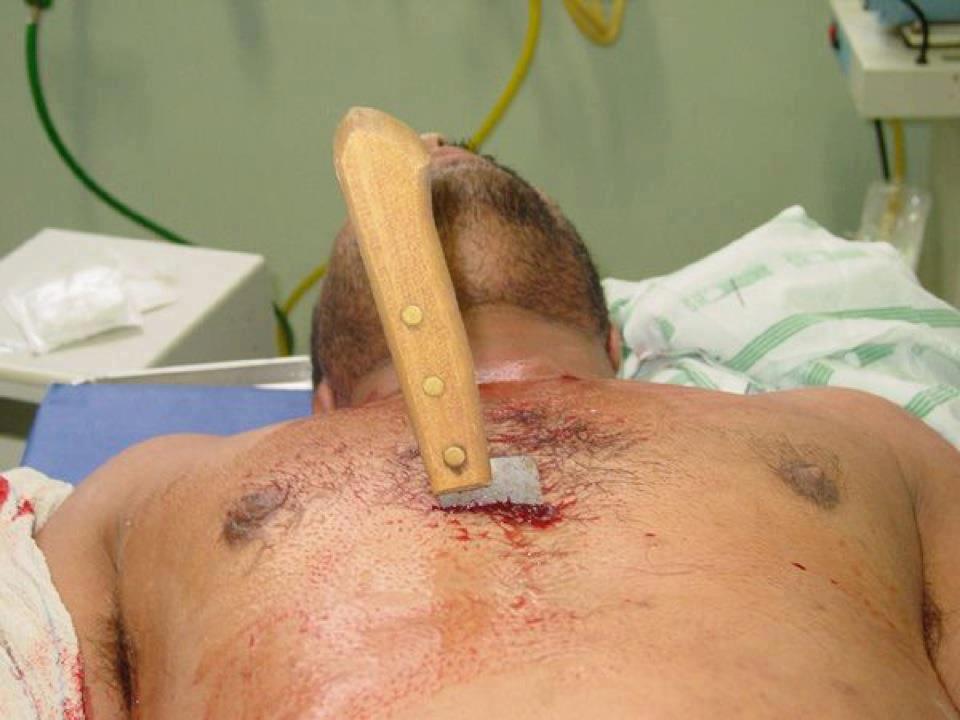 ⁣Knife Stabbed Inside Chest Removal Surgery