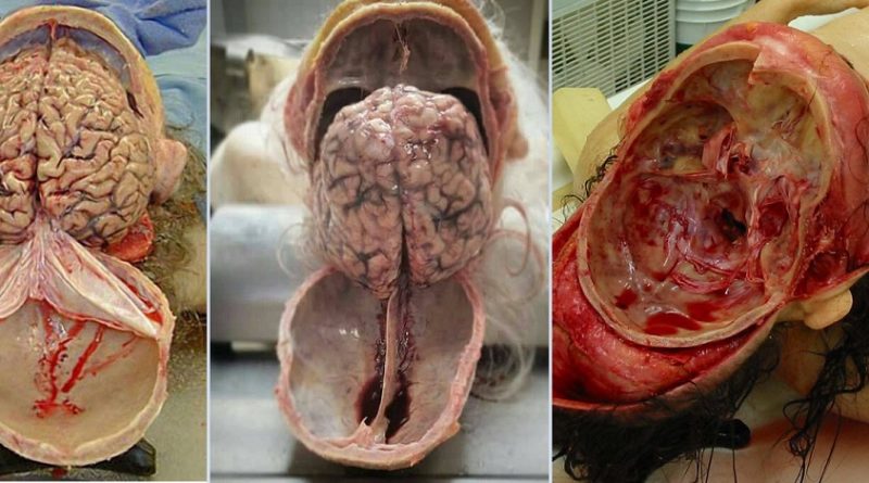 ⁣Human Skull Opening and Brain Removal During Autopsy