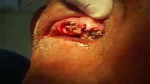 ⁣Medical Videos - Pulling Out Teeth Full of Worms