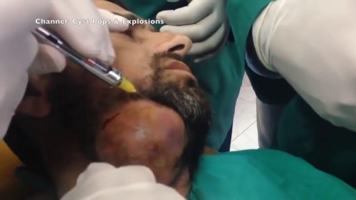 ⁣Worlds largest Face Abscess Draining