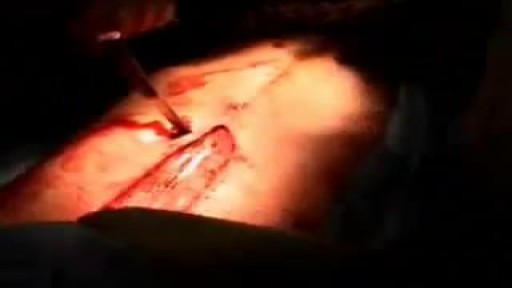 ⁣Knife Stabbed Inside Chest Removing Surgery