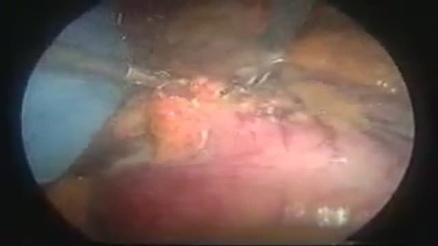 Mini Gastric Bypass Operation Video