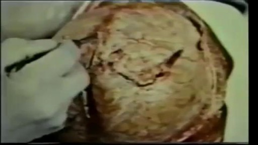 ⁣Medical Videos - Brain Removal During Autopsy