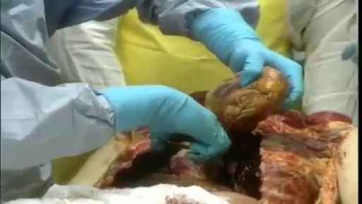 ⁣Medical Videos - Human Body Autopsy for Poison