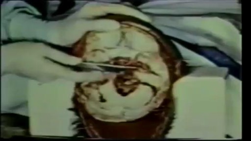 Human Brain Removal During Autopsy