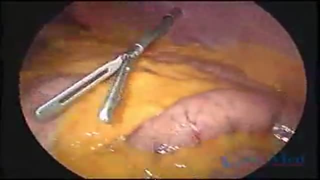 Laparoscopic Sleeve Gastrectomy