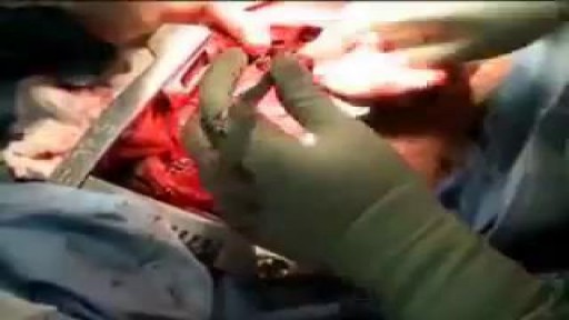 ⁣Knife Stab Inside Chest Removal Surgery
