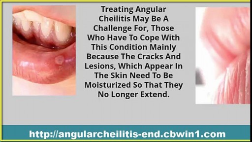 ⁣Cracked Lip Corners, Angular Cheilitis Treatment, Angular Cheilitis Home Remedies, Angular Cheilitis