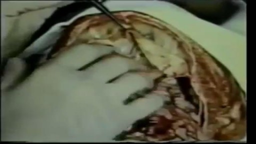 ⁣Human Brain Removal During Medical Autopsy