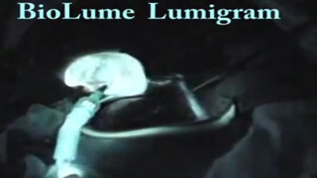 ⁣Gall bladder Lumigram