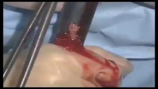 ⁣human Fetus Removal Surgery