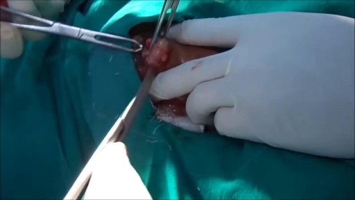 ⁣Fibrodenoma Removal With Local Anesthesia
