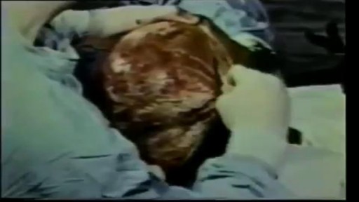 Medical Videos - Human Brain Removal During Autopsy