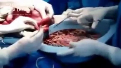 ⁣Bodybuilder's Colon Full of 10 lbs Meat Worms