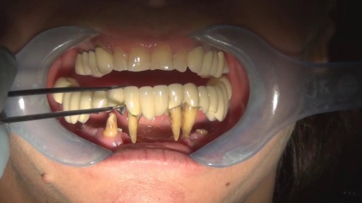 ⁣Removing Front Teeth