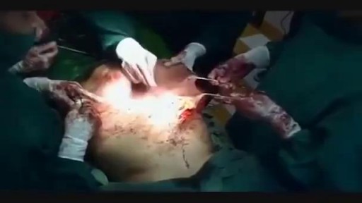 ⁣Huge Stomach Tumor Removal Medical Surgery