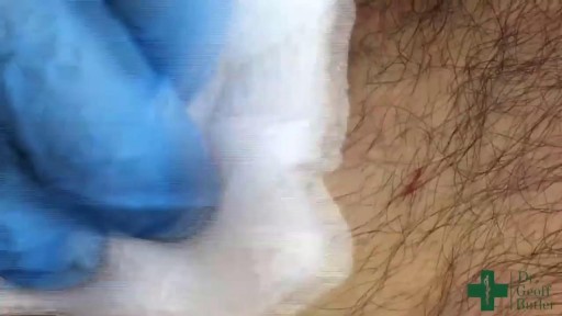 ⁣Medical Videos - Huge Skin Cyst Removal Surgery
