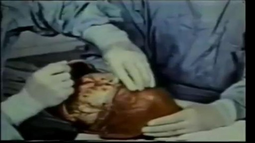 Human Brain Removal During Medical Autopsy Procedure