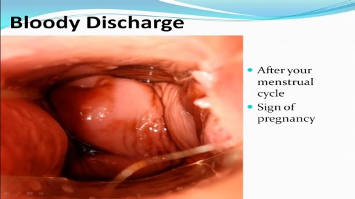 ⁣Medical Videos - Types of Female Genital discharge