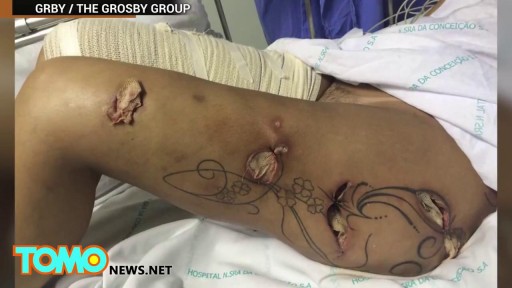 ⁣Butt and Legs Implants Exploded Inside Brazilian Model