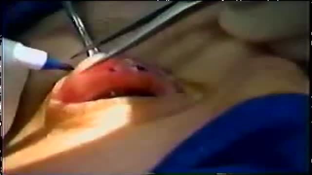 Modified Mullerectomy