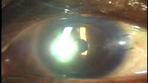 Corneal Transplant Surgery