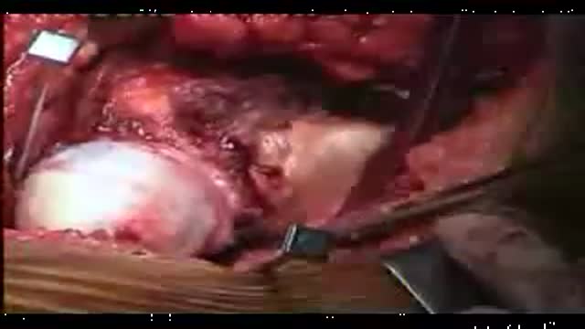 Birmingham Hip Resurfacing Surgery- Vijay Bose_Part 2