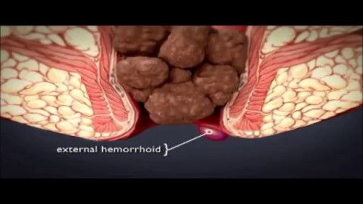 ⁣What are Hemorrhoids
