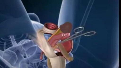 ⁣Man to Woman Sex Change Surgery Animation