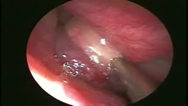 Drainage of a maxillary Sinus pyocoele