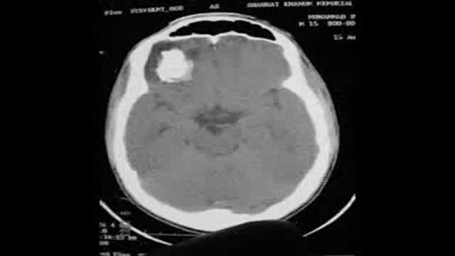 Calcified Brain Abscess