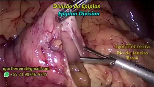 Bariatric Surgery - Sleeve Gastrectomy