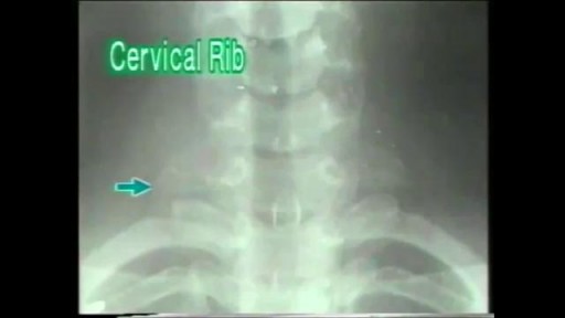 ⁣Cervical Rib - X-ray