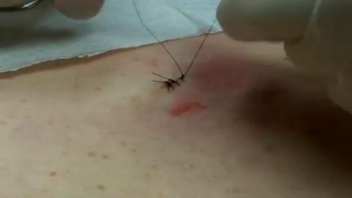 Mole Removal Surgery and Stitches