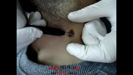 ⁣Mole (NEVUS) Removal With Radio Frequency