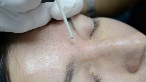 ⁣Nevus  removal by radiowave surgery