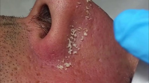 ⁣Giant Blackheads Removal