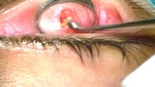 ⁣Chalazion Eyelid Surgery